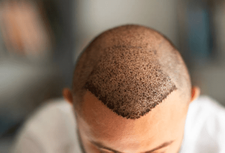 sac-ekimi-fiyatlari-2026